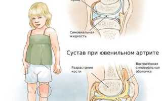 Ревматоидный артрит – воспаление суставов у детей