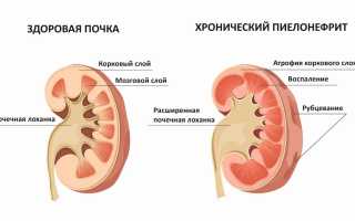 Пиелонефрит у детей