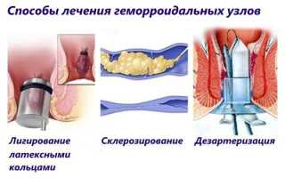 Изучим геморрой у представителей сильного пола