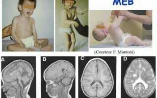 Гипоплазия червя мозжечка у ребенка