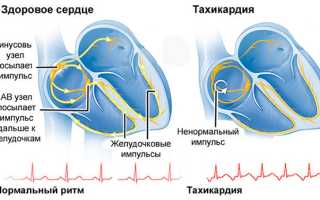 Можно ли вылечить тахикардию: принципы лечения, эффективные препараты, лекарства, таблетки для сердца