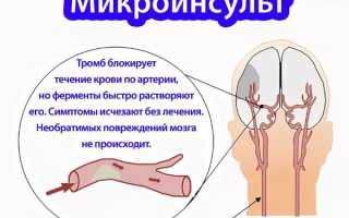 Всё о микроинсульте: первые признаки и симптомы, лечение и восстановление, причины и последствия