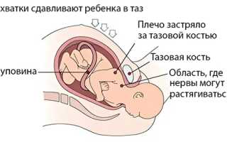 Родовые травмы у детей