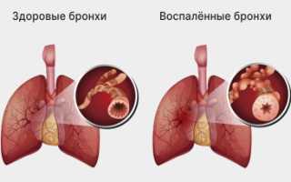 Как лечить обструктивный бронхит у ребенка дома?