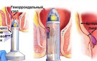 Как проводят дезартеризацию геморроидальных узлов