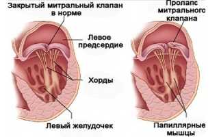 Пролапс митрального клапана у детей