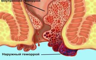Обзор лучших и эффективных лекарств от геморроя: свечи, мази, таблетки