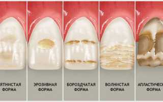 Гипоплазия эмали у ребенка