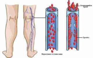 Тромбоз подколенной вены: причины, симптомы и лечение