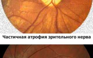 Атрофия зрительного нерва у детей