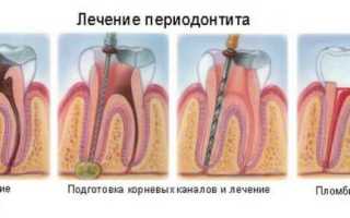Виды периодонтитов: как определить и лечить заболевание