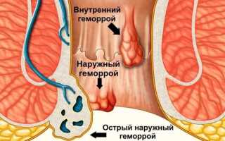 Можно ли применять мазь «Левомеколь» при геморрое и какие отзывы получает это лекарственное средство