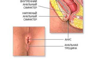 Каковы последствия геморроя?