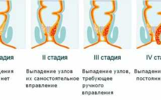 Что такое склеротерапия геморроидальных узлов: процедура проведения, последствия, отзывы пациентов