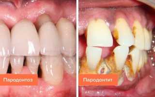 Как отличить пародонтоз от пародонтита: сходства и различия заболеваний