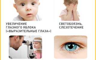 Глаукома у детей