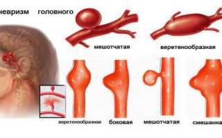 Причины возникновения, симптомы, лечение и последствия аневризмы головного мозга