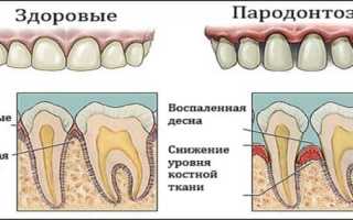 Причины пародонтоза у взрослых и лечение в домашних условиях