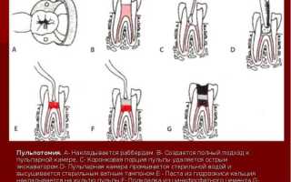 Гной в канале зуба: как лечится гнойный пульпит