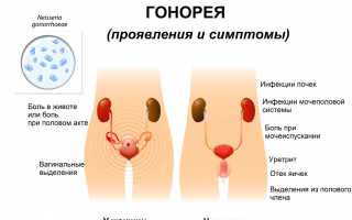 Венерическое заболевание – гонорея у ребенка