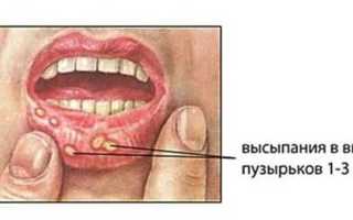 Энтеровирусный стоматит: лечение везикулярной инфекции