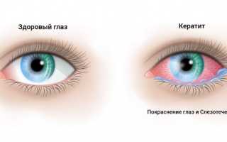 Кератит у детей: чем опасно воспаление роговицы глаза?