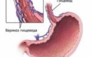 Варикозное расширение вен пищевода: степени, симптомы, лечение