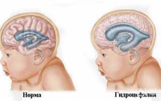 Гидроцефалия головного мозга (водянка) у детей