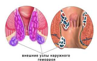 Если геморрой не вправляется