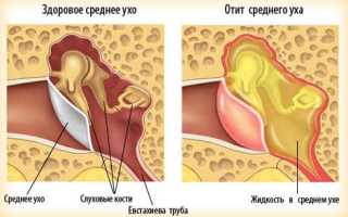 Экссудативный отит у ребенка