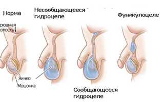 Киста семенного канатика у ребёнка