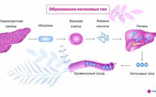 Что делать если в моче у ребенка обнаружены кетоновые тела?