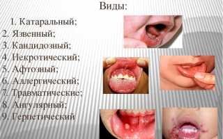Как лечить язвенный стоматит у детей?