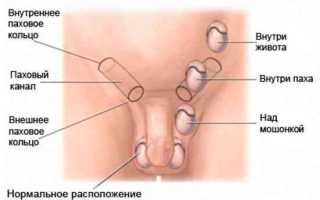 Крипторхизм у детей