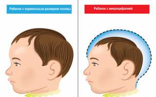 Симптомы и лечение олигофрении у детей