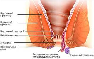 Как хорошо помогают свечи Постеризан при геморрое: обзор отзывов и инструкции по применению