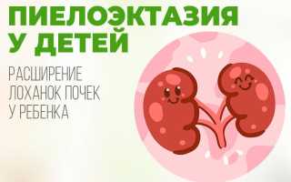 Пиелоэктазия почек у детей