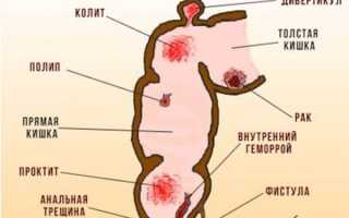 Почему кровоточит геморрой и как остановить кровотечение в домашних условиях