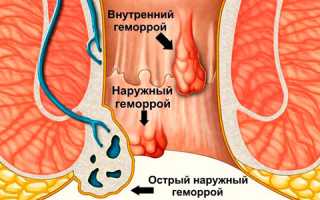 Как проводится диагностика геморроя?