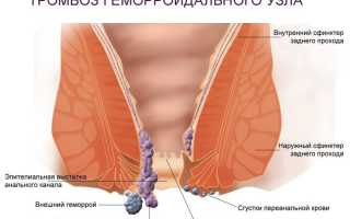 Появились геморроидальные узлы при вынашивании ребенка