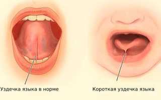 Короткая уздечка языка у ребенка – что делать?